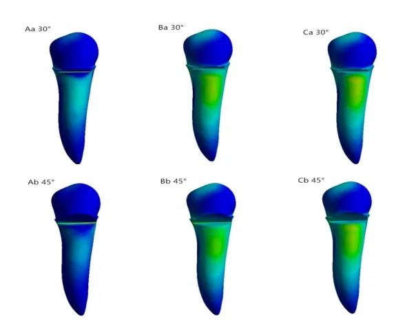 工況中牙本質 Von mises 應力分布云圖