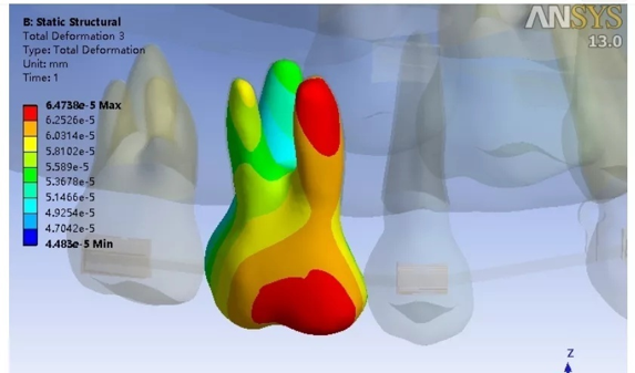 牙齒有限元分析