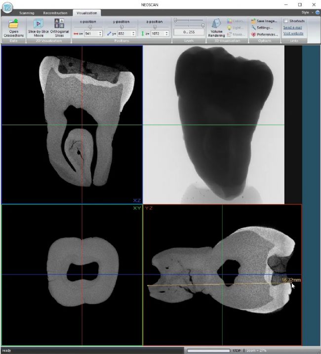 臺式顯微 CT 以 9.8 μm 像素大小掃描一顆臼齒,顯示牙本質和牙釉質中存在裂紋,填充材料被腐蝕。
