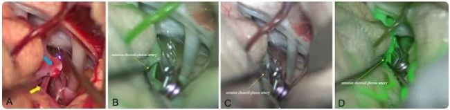 顯微課堂 | 動脈瘤夾閉:使用 AR 熒光實時評估穿支血管