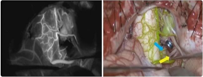 顯微課堂 | 動脈瘤夾閉:使用 AR 熒光實時評估穿支血管